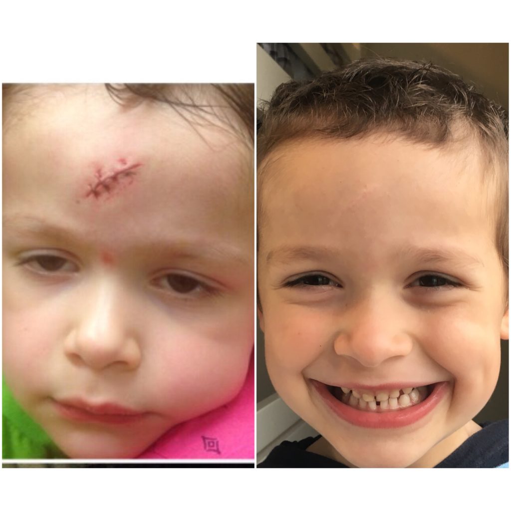 Sawyer Maddox, left, at three, and right, after treatment,at five